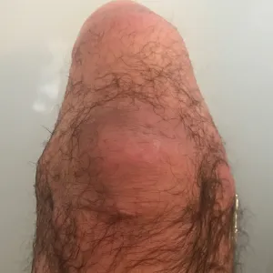 LeglessBear